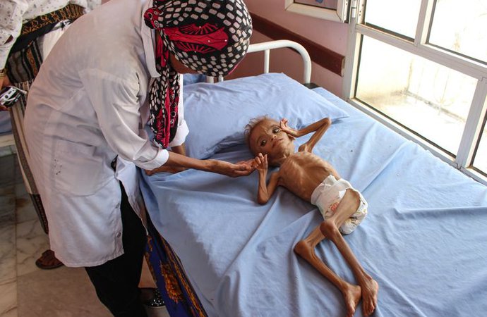 famine-yemen.jpg